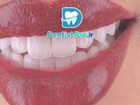 ترمیم زیبایی دندان با کامپوزیت لایه ای: هنر و علم زیبایی دندانپزشکی