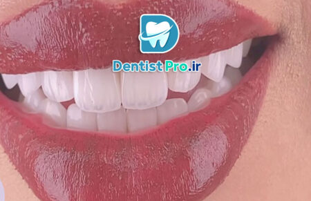 ترمیم زیبایی دندان با کامپوزیت لایه ای: هنر و علم زیبایی دندانپزشکی