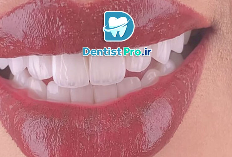 ترمیم زیبایی دندان با کامپوزیت لایه ای: هنر و علم زیبایی دندانپزشکی 39 ترمیم زیبایی دندان با کامپوزیت لایه ای: هنر و علم زیبایی دندانپزشکی