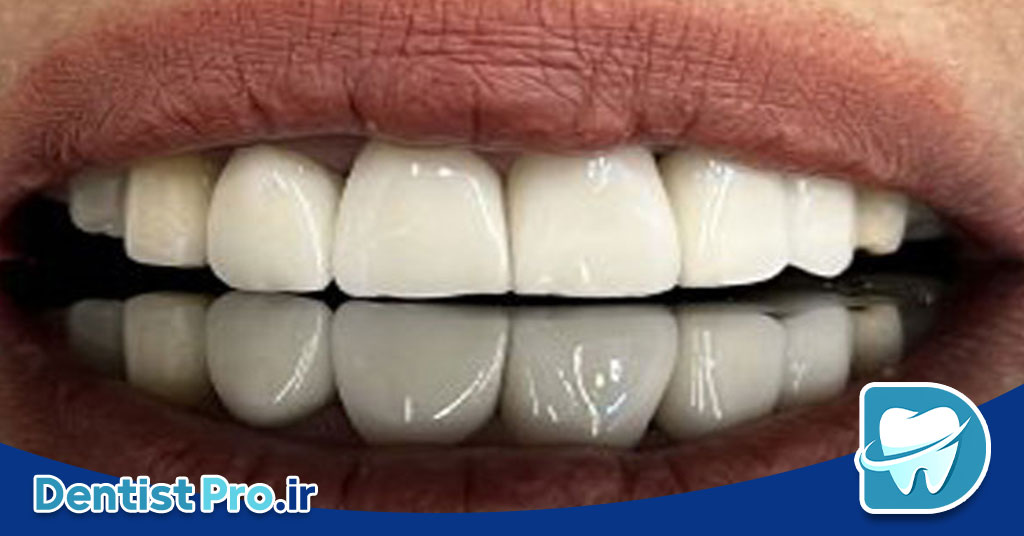 ترمیم زیبایی دندان با کامپوزیت لایه ای: هنر و علم زیبایی دندانپزشکی