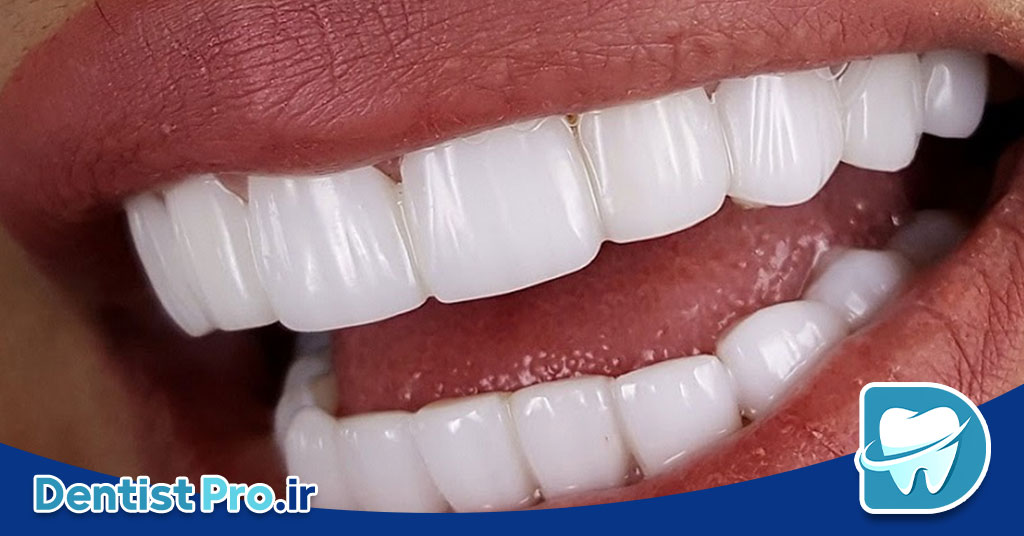 کامپوزیت نانو هیبریدی دندان: ترکیبی از زیبایی و استحکام در ترمیمهای دندانی 26 کامپوزیت نانو هیبریدی دندان: ترکیبی از زیبایی و استحکام در ترمیمهای دندانی