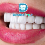 کامپوزیت نانو هیبریدی دندان: ترکیبی از زیبایی و استحکام در ترمیم‌های دندانی