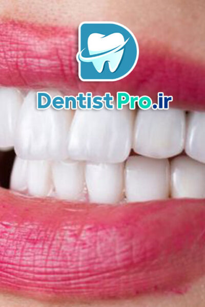 کامپوزیت نانو هیبریدی دندان: ترکیبی از زیبایی و استحکام در ترمیم‌های دندانی