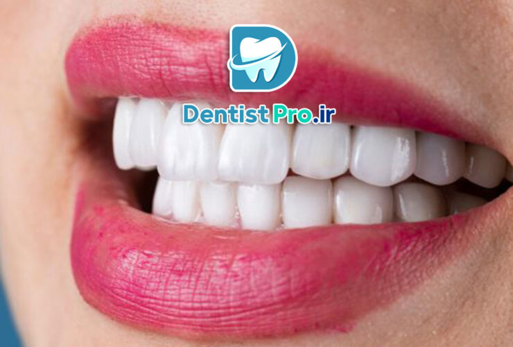 کامپوزیت نانو هیبریدی دندان: ترکیبی از زیبایی و استحکام در ترمیم‌های دندانی