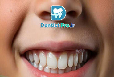 ترمیم دندان با کامپوزیت بیو سازگار کودکان: راهکاری نوین در دندانپزشکی کودکان