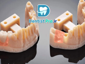 پرکردن کامپوزیتی دیجیتال با فناوری چاپ سه بعدی