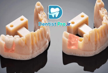 پرکردن کامپوزیتی دیجیتال با فناوری چاپ سه بعدی