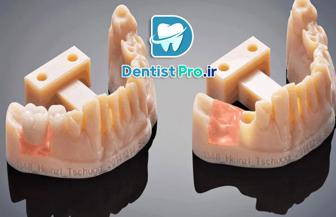 پرکردن کامپوزیتی دیجیتال با فناوری چاپ سه بعدی 25 پرکردن کامپوزیتی دیجیتال با فناوری چاپ سه بعدی