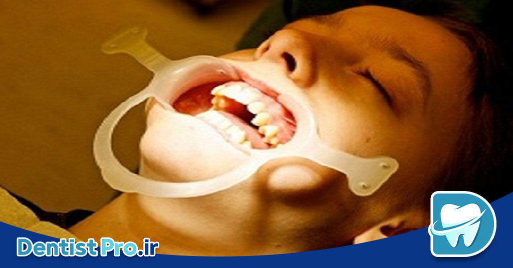 تشخیص زودهنگام ناهنجاری های فکی کودکان 26 تشخیص زودهنگام ناهنجاری های فکی کودکان