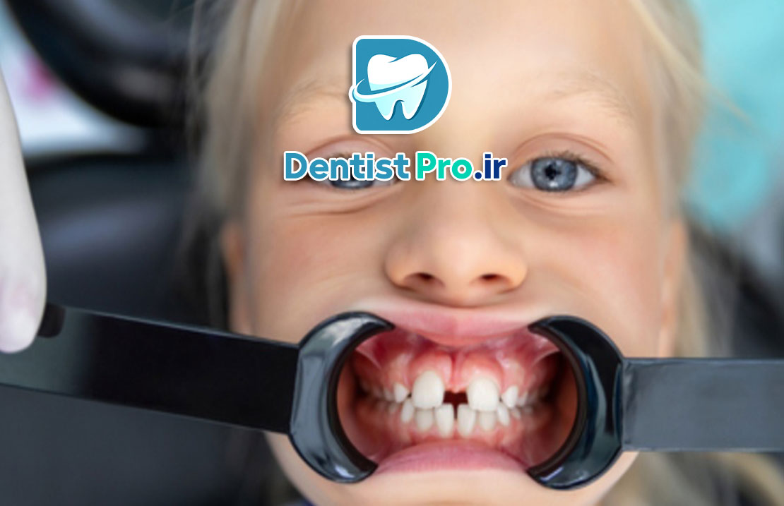 تشخیص زودهنگام ناهنجاری های فکی کودکان 25 تشخیص زودهنگام ناهنجاری های فکی کودکان