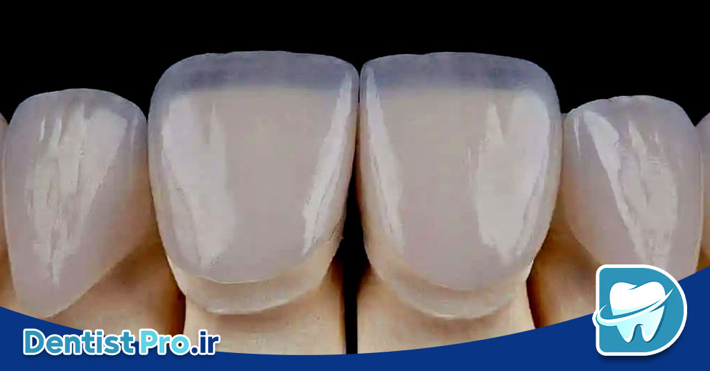 ونیر سرامیکی فلدسپاتیک: زیبایی و دوام در دندانپزشکی