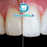 ونیر سرامیکی فلدسپاتیک: زیبایی و دوام در دندانپزشکی