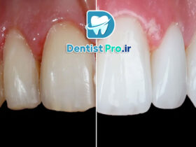 ونیر سرامیکی فلدسپاتیک: زیبایی و دوام در دندانپزشکی