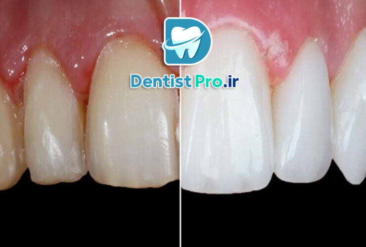 ونیر سرامیکی فلدسپاتیک: زیبایی و دوام در دندانپزشکی