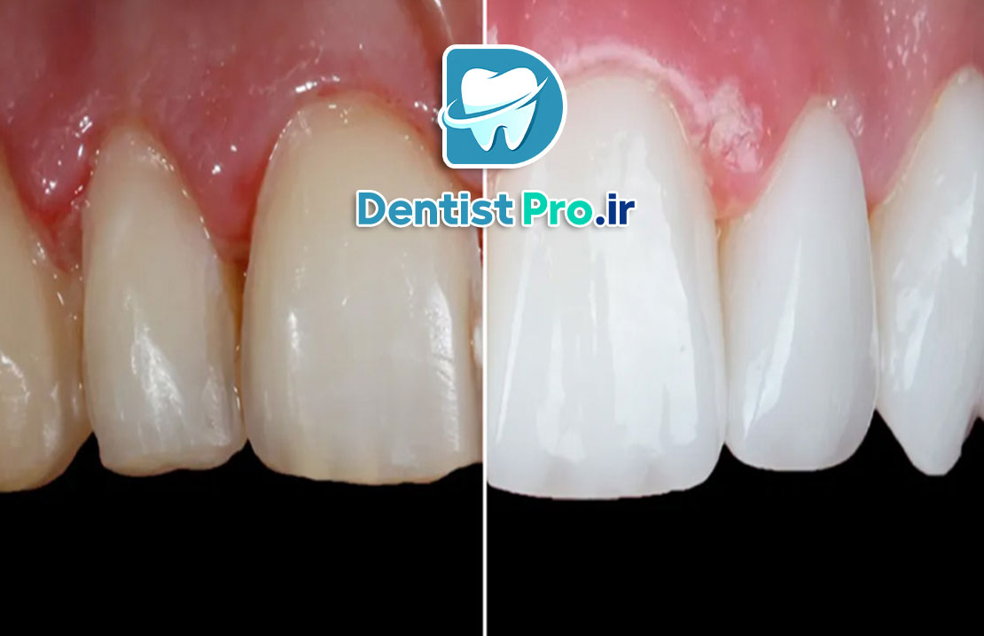 ونیر سرامیکی فلدسپاتیک: زیبایی و دوام در دندانپزشکی
