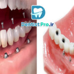 پروتز ثابت ایمپلنت با پوشش سرامیکی چندلایه: مروری جامع