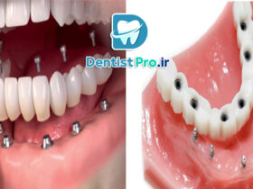 پروتز ثابت ایمپلنت با پوشش سرامیکی چندلایه: مروری جامع