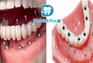 پروتز ثابت ایمپلنت با پوشش سرامیکی چندلایه: مروری جامع