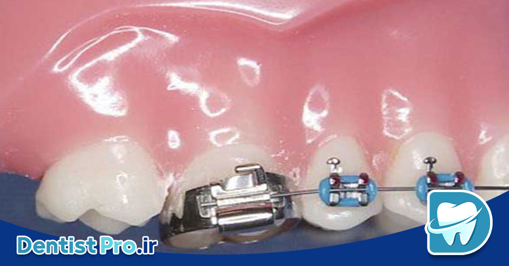 تثبیت دندان های شیری با حلقه فلزی: اهمیت، کاربردها و تکنیک‌ها