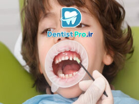 تثبیت دندان های شیری با حلقه فلزی: اهمیت، کاربردها و تکنیک‌ها