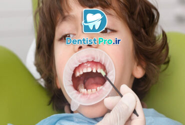 تثبیت دندان های شیری با حلقه فلزی: اهمیت، کاربردها و تکنیک‌ها