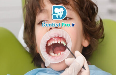 تثبیت دندان های شیری با حلقه فلزی: اهمیت، کاربردها و تکنیک‌ها