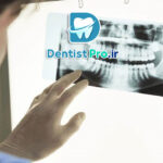 تصویر برداری فلورسانس برای تشخیص پوسیدگی نهفته