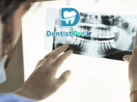 تصویر برداری فلورسانس برای تشخیص پوسیدگی نهفته