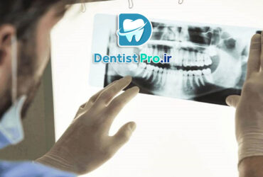 تصویر برداری فلورسانس برای تشخیص پوسیدگی نهفته