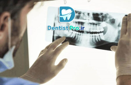 تصویر برداری فلورسانس برای تشخیص پوسیدگی نهفته