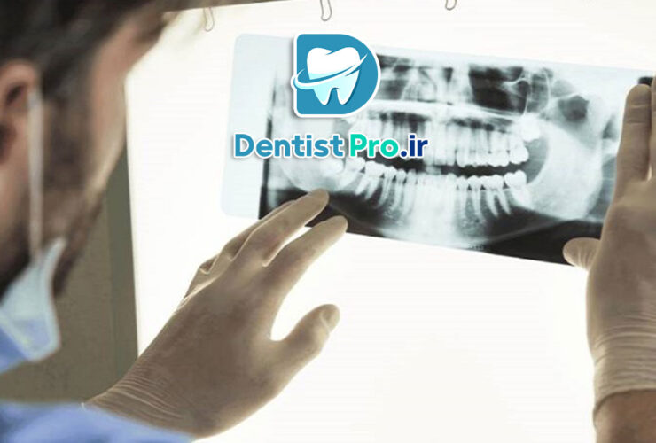 تصویر برداری فلورسانس برای تشخیص پوسیدگی نهفته