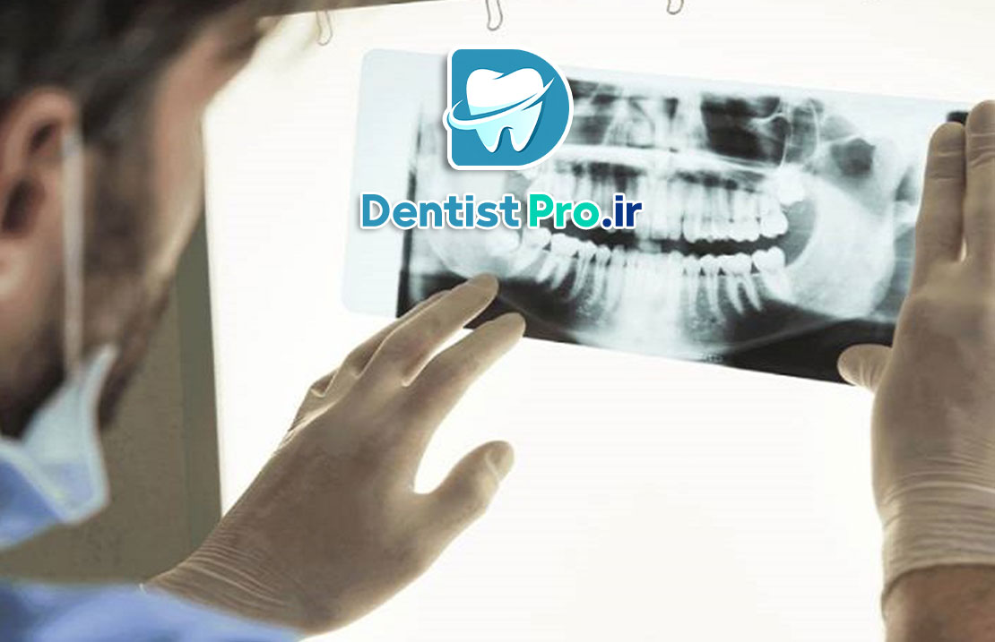 تصویر برداری فلورسانس برای تشخیص پوسیدگی نهفته 25 تصویر برداری فلورسانس برای تشخیص پوسیدگی نهفته