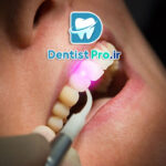 جراحی ترمیمی لثه با لیزر اربیوم فوق پیشرفته: راهکاری نوین برای درمان بیماری‌های لثه