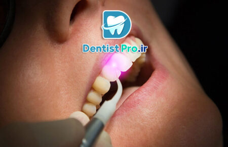 جراحی ترمیمی لثه با لیزر اربیوم فوق پیشرفته: راهکاری نوین برای درمان بیماری‌های لثه