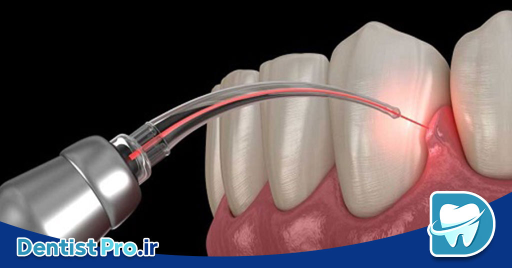 جراحی ترمیمی لثه با لیزر اربیوم فوق پیشرفته: راهکاری نوین برای درمان بیماریهای لثه 26 جراحی ترمیمی لثه با لیزر اربیوم فوق پیشرفته: راهکاری نوین برای درمان بیماریهای لثه