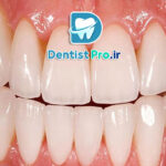 ونیر پرسلن با دوام بالا: راهکاری ماندگار برای زیبایی لبخند