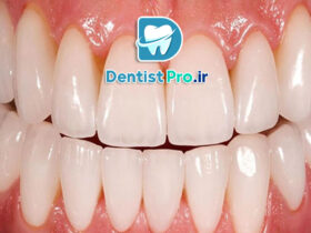 ونیر پرسلن با دوام بالا: راهکاری ماندگار برای زیبایی لبخند