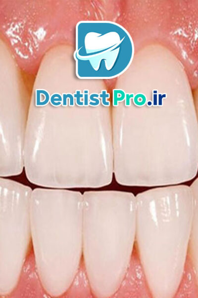 ونیر پرسلن با دوام بالا: راهکاری ماندگار برای زیبایی لبخند