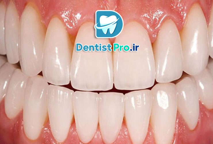 ونیر پرسلن با دوام بالا: راهکاری ماندگار برای زیبایی لبخند