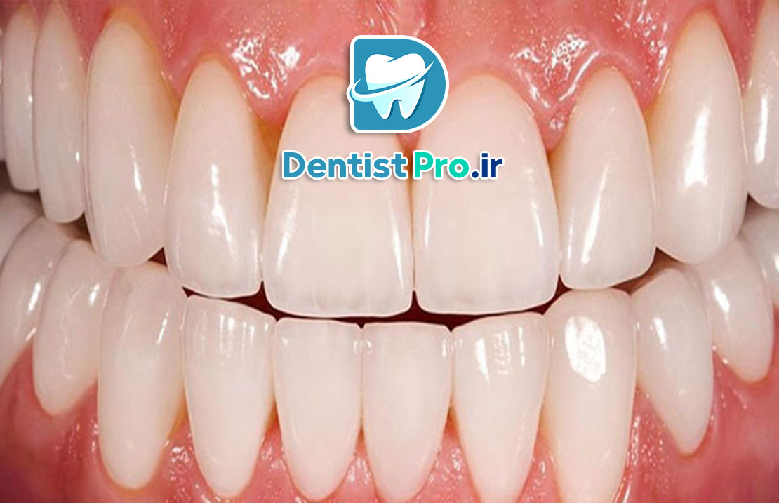 ونیر پرسلن با دوام بالا: راهکاری ماندگار برای زیبایی لبخند