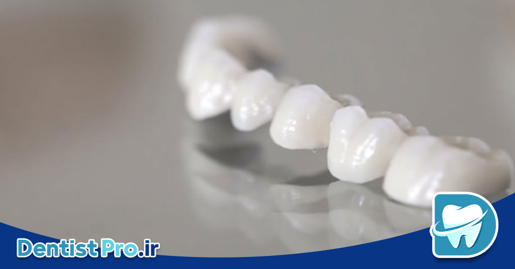 ونیر پرسلن با دوام بالا: راهکاری ماندگار برای زیبایی لبخند