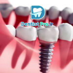 ایمپلنت زیبایی فوری: راهکاری نوین برای بازگرداندن زیبایی و اعتماد به نفس