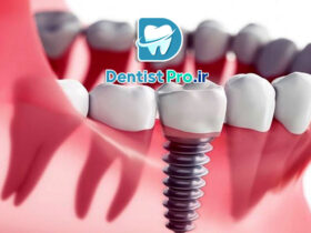 ایمپلنت زیبایی فوری: راهکاری نوین برای بازگرداندن زیبایی و اعتماد به نفس