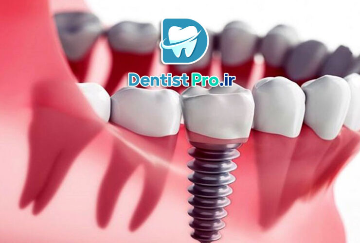 ایمپلنت زیبایی فوری: راهکاری نوین برای بازگرداندن زیبایی و اعتماد به نفس