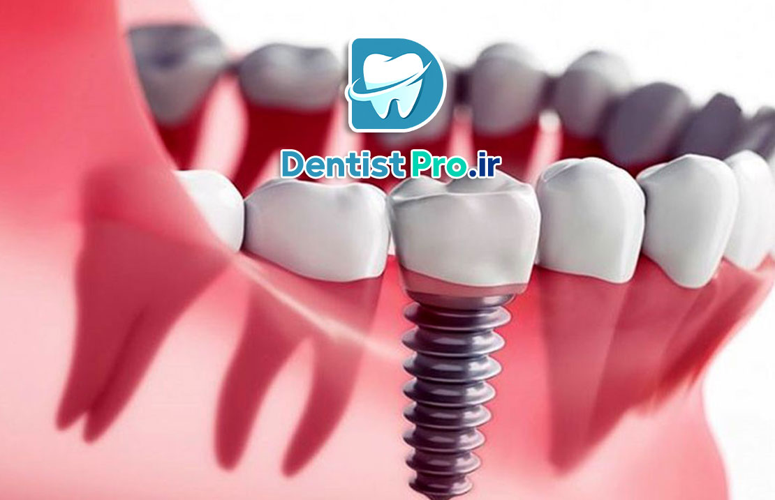 ایمپلنت زیبایی فوری: راهکاری نوین برای بازگرداندن زیبایی و اعتماد به نفس