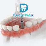 فناوری‌های به‌کار رفته در کاشت ایمپلنت با استفاده از گاید جراحی دیجیتال