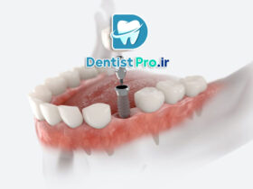 فناوری‌های به‌کار رفته در کاشت ایمپلنت با استفاده از گاید جراحی دیجیتال