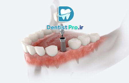 فناوری‌های به‌کار رفته در کاشت ایمپلنت با استفاده از گاید جراحی دیجیتال