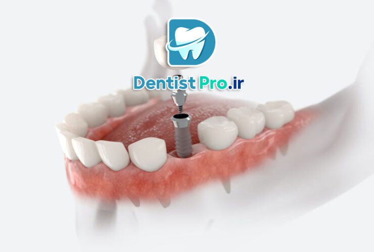 فناوری‌های به‌کار رفته در کاشت ایمپلنت با استفاده از گاید جراحی دیجیتال