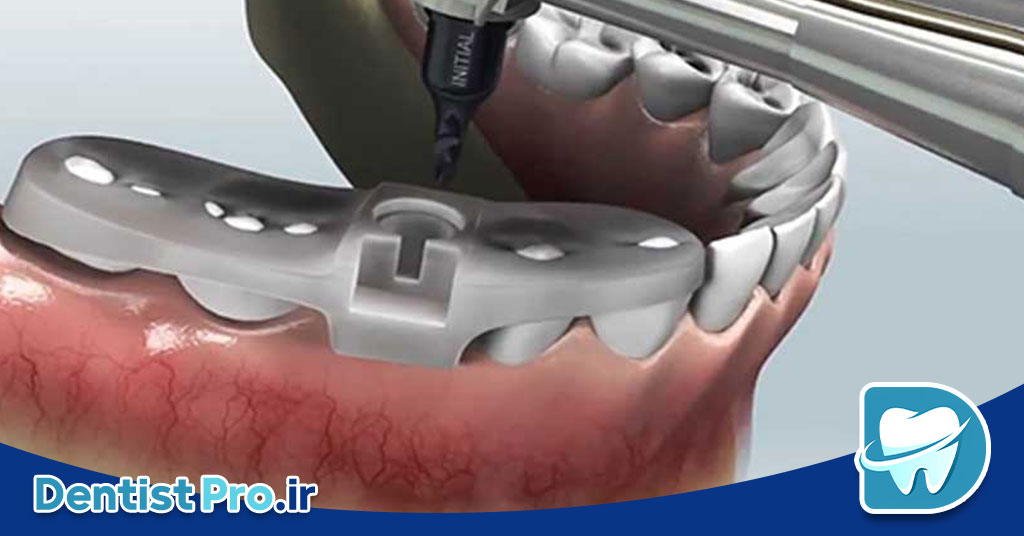 فناوریهای بهکار رفته در کاشت ایمپلنت با استفاده از گاید جراحی دیجیتال 26 فناوریهای بهکار رفته در کاشت ایمپلنت با استفاده از گاید جراحی دیجیتال